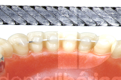 Plane wire lingual retainer 1,5m retenue linguale leone
